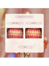 プラスビーセルフ(+b self)/ホワイトニングビフォーアフター