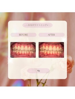 プラスビーセルフ(+b self)/ホワイトニングビフォーアフター