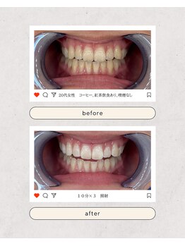 スマイルプライベートビューティサロン(Smile)/セルフホワイトニング