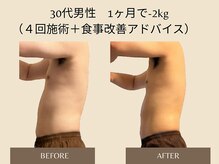 オベリオ(OBERIO)/ハイパーナイフ全身痩身施術