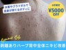大人気8月続行!背中全面剥離ハーブピーリング【5000円OFF】顔の3倍量：腕脚◎