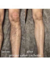 カシェット(cachette)/メンズ脱毛