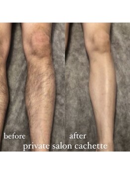 カシェット(cachette)/メンズ脱毛