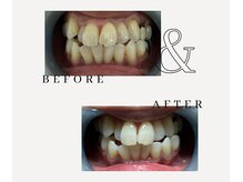 とぅるりん 肌質改善/お試しあれ★一回で驚きの白さ！