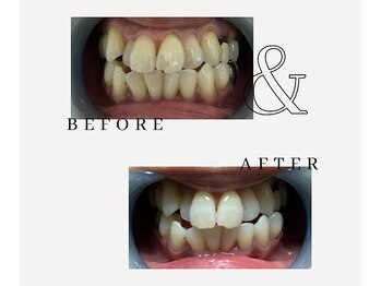 とぅるりん 肌質改善/お試しあれ★一回で驚きの白さ！