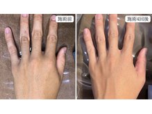 トパーズ 藤枝店(Topaz)/手の指.甲脱毛 藤枝/焼津/島田