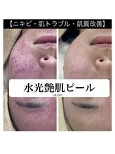 レピア(Le'pia)/水光艶肌ピーリング
