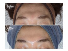 エボルブ 四条烏丸店(EVOLVE)/額のシワ改善！