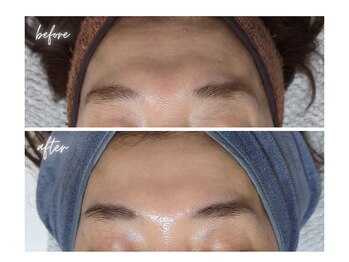 エボルブ 四条烏丸店(EVOLVE)/額のシワ改善!