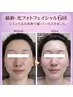 【春の透明感UP】光フォト90分◆シミ・くすみ改善でノーファンデ肌へ