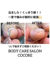 ココリ(CoCoRe)/巻いて食い込んでいる爪