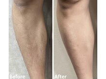 グレイス(Grace)/メンズひざ下脱毛