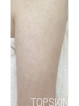 トップスキン 名駅(TOPSKIN)/毛○性苔癬のお悩みにも!