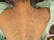 はりきゅう和 ルート鍼灸院/お試し15分で