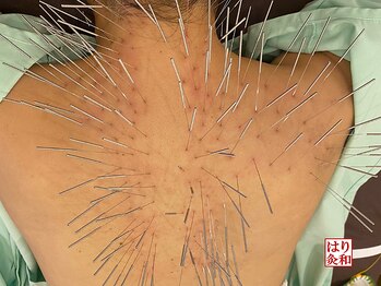 はりきゅう和 ルート鍼灸院/お試し15分で