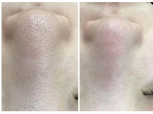 クラティス 伊那店(CRATIS)/毛穴の黒ずみ改善