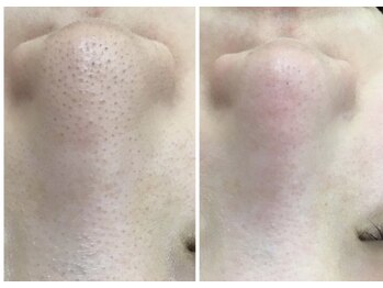 クラティス 伊那店(CRATIS)/毛穴の黒ずみ改善