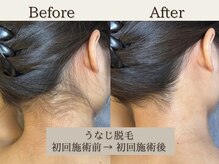 インベスト(INVEST)/うなじ脱毛