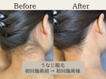 インベスト(INVEST)/うなじ脱毛