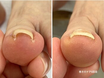 コバコ(kobaco)/巻き爪ケア　6回目