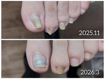 【巻き爪リフト／ＰＢスパンゲ】