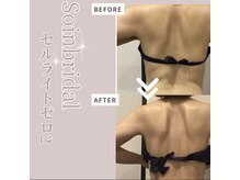 ソワン 小岩店(Soin)/30代　背中二の腕集中