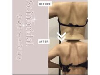 ソワン 小岩店(Soin)/30代 背中二の腕集中