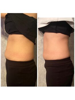 エノアシュエット(Enoachouette)の写真/運動嫌いでも効果あり◎短期集中でリバウンドにサヨナラ!最新痩身で理想の体へ♪