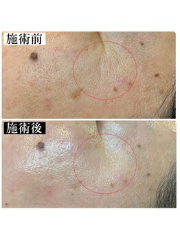 ヘルバ(HERBA)/フェイシャル