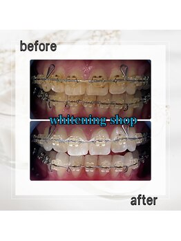 ホワイトニングショップ 亀戸店/【亀戸】美白ホワイトニング