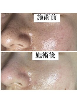 イリゼ(iriser)/プラズマフェイシャル