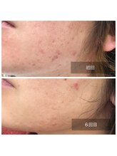 ミドリ(MIDORI)/繰り返すニキビ徹底ケア症例2-2