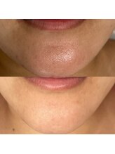 ルーム(room)/エルモサハーブ2回