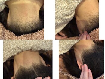 ビューティ ケア ルーム メロウ(Beauty Care Room Moelleux)/うなじ脱毛