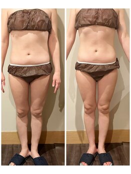 ルネ(Lune)/～施術前と施術後のお写真撮影～