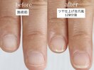 ツヤのある自爪風の深爪矯正