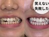 【残り10名】黄ばみに限界を感じた方へ。他で白くならなかった方こそ体験を