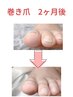 巻き爪お悩みの方　初回はお電話かLINEにてお問い合わせするとスムーズです