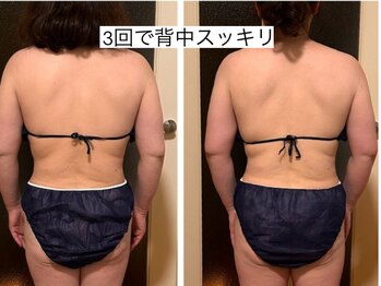 ヨサパーク エクラエム(YOSAPARK eclat.emu)/3回で背中スッキリ