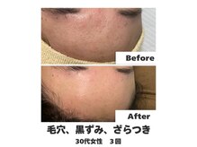 ラナン パラフューズ(Ranun's PARAFUSE.)/ざらつきがなくなってつるん肌へ