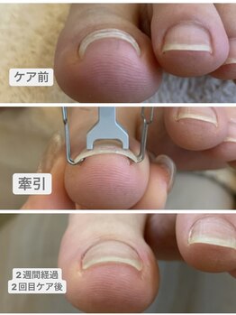 サロン ケー(Salon K)/巻き爪ケア始めました♪