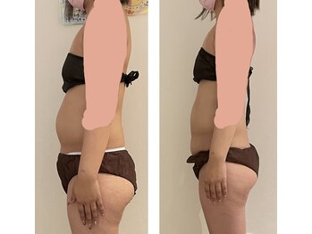 サロン ド モナ(salon de mona)/【脂肪冷却ビフォーアフター】