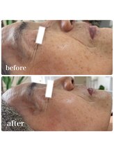 エステサロンブランシュ(Esthe salon Blanche)/ハーブピーリングでシワケア