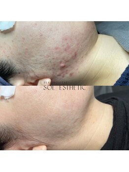 プランス 渋谷(PLANCE)/韓国/肌管理/ニキビケア/毛穴