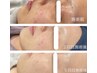 【肌質改善×大人ニキビ】〔艶肌、再生ケア〕艶玉導入¥7700→5500