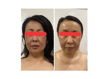 ランス/1回の施術での変化