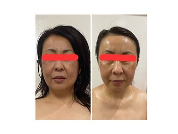 ランス/1回の施術での変化