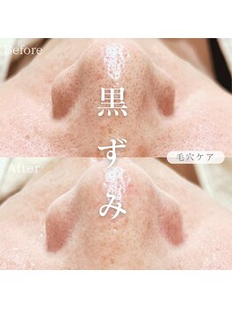 オーキッド(ORCHID)/毛穴ケア♪