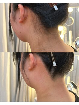 シェリー(Cherie)/うなじWAX+光脱毛