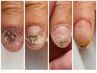深爪矯正プログラムの方はこちら！/リピーター様